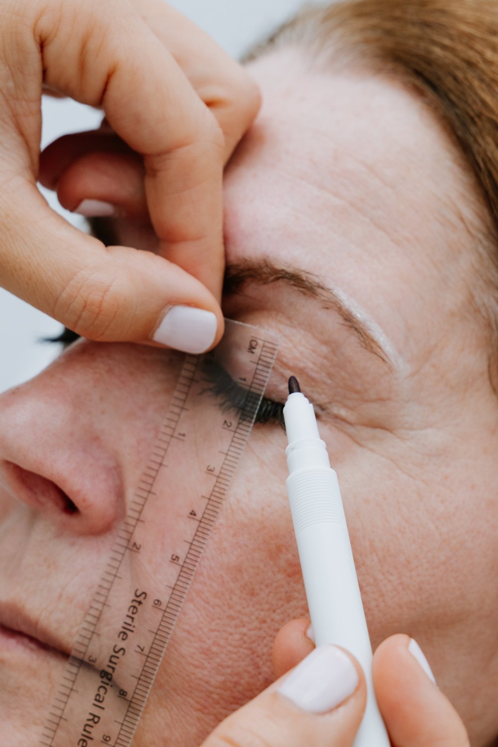 Blefaroplastia